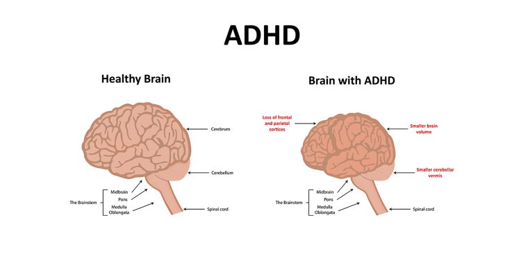 ADHD and School ADHD Brain
