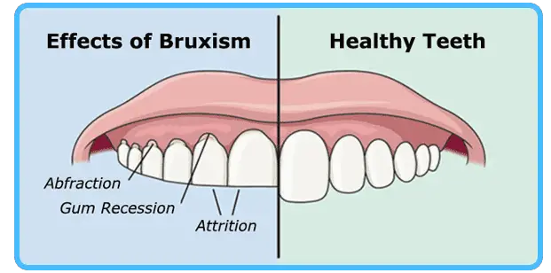 Vyvanse Side Effects Bruxism