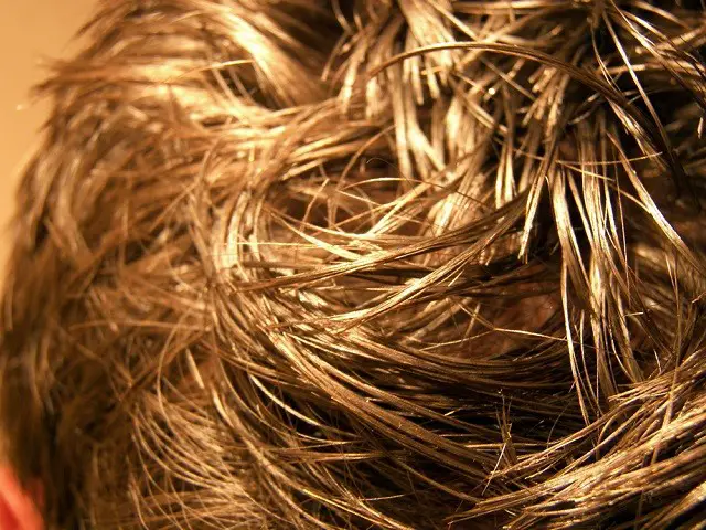 Does Vyvanse Cause Hair Loss Extremely Rare Side Effect